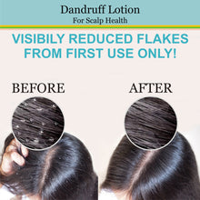 Load image into Gallery viewer, dandruff lotion, hair fall, hair care, dandruff hair lotion, prevent dandruff, flaky scalp, boost hair growth, hair fall repair shampoo, dandruff shampoo, hair oil for dandruff, healthy hair care, organic hair care products, zenvista, organic skincare, hair growth, vitamin c,
